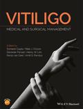 Vitiligo 