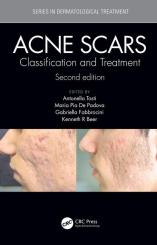 Acne Scars 