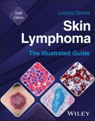 Skin Lymphoma 