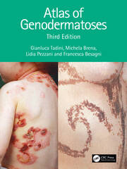Atlas of Genodermatoses 