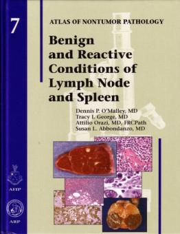 Benign and Reactive Conditions of the Lymph Node and Spleen 