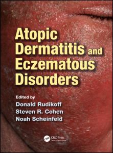 Atopic Dermatitis and Eczematous Disorders 