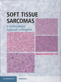 Soft Tissue Sarcomas 